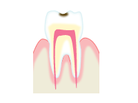 虫歯の進行と治療方法